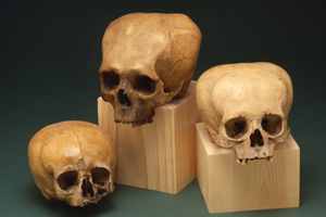 Deformacions cranial